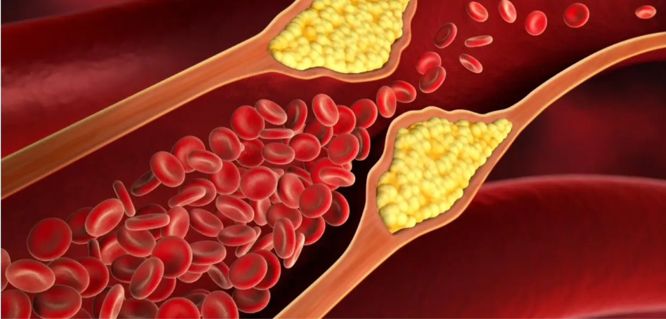 शरीर में सबसे अधिक कोलेस्ट्रॉल कहाँ होता है? इन पांच बीमारियों से दिल का दौरा हो सकता है 1 cholesterol